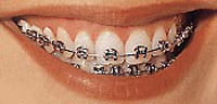 Metal Braces